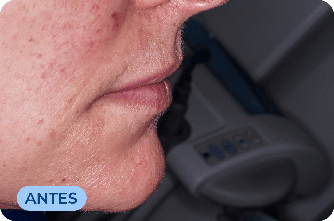 Rejuvenescimento Facial com CGF