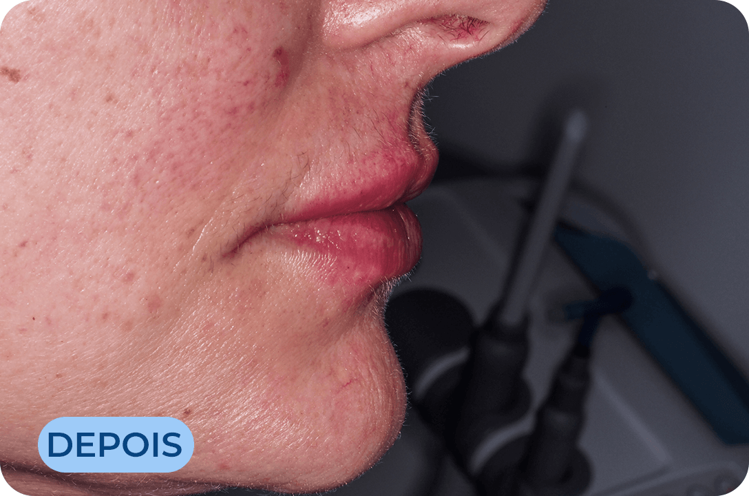 Rejuvenescimento Facial com CGF