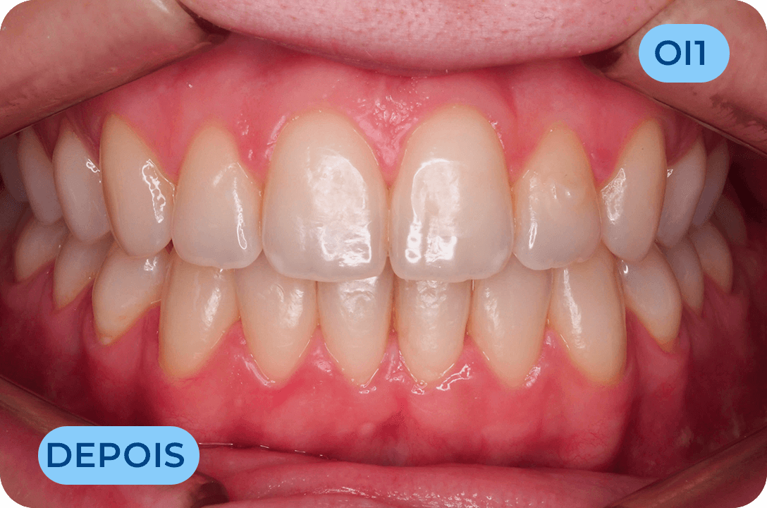 Ortodontia Invisivel