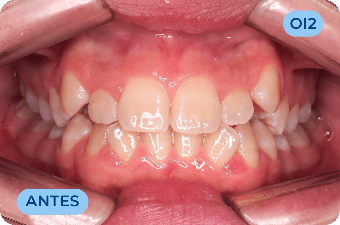 Ortodontia Invisivel