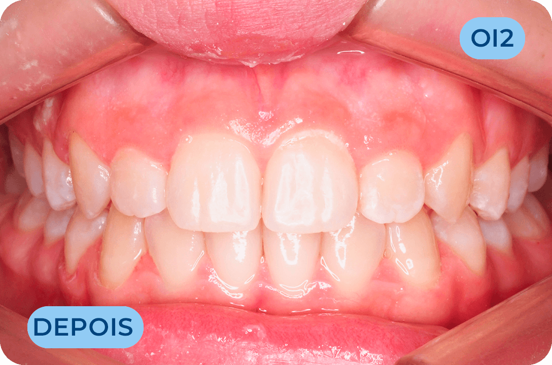 Ortodontia Invisivel