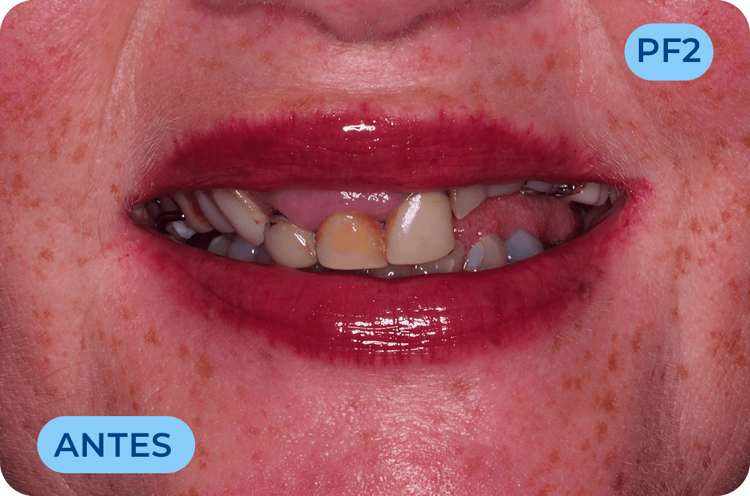 Protese Total Fixa Com Implantes