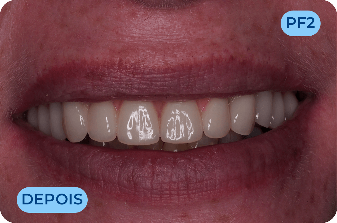 Protese Total Fixa Com Implantes