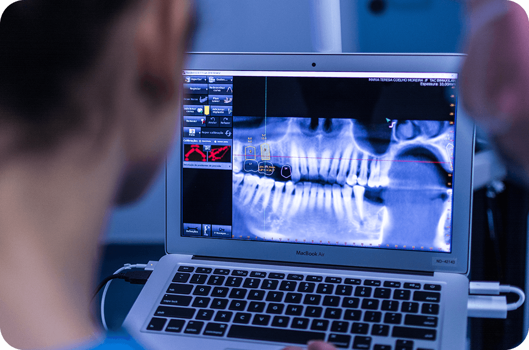 Cirurgia Guiada em Implantologia